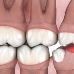 Zobna kirurgija Luxdental